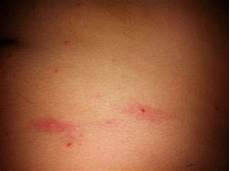Blister Soaps
