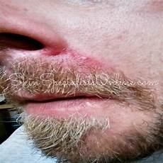 Blister Soaps